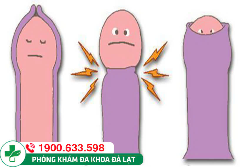 NGHẸT BAO QUY ĐẦU LÀ GÌ? PHƯƠNG PHÁP ĐIỀU TRỊ HIỆU QUẢ NHẤT!